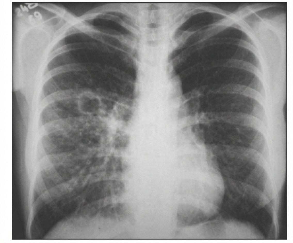 Imagem da questão de Tuberculose