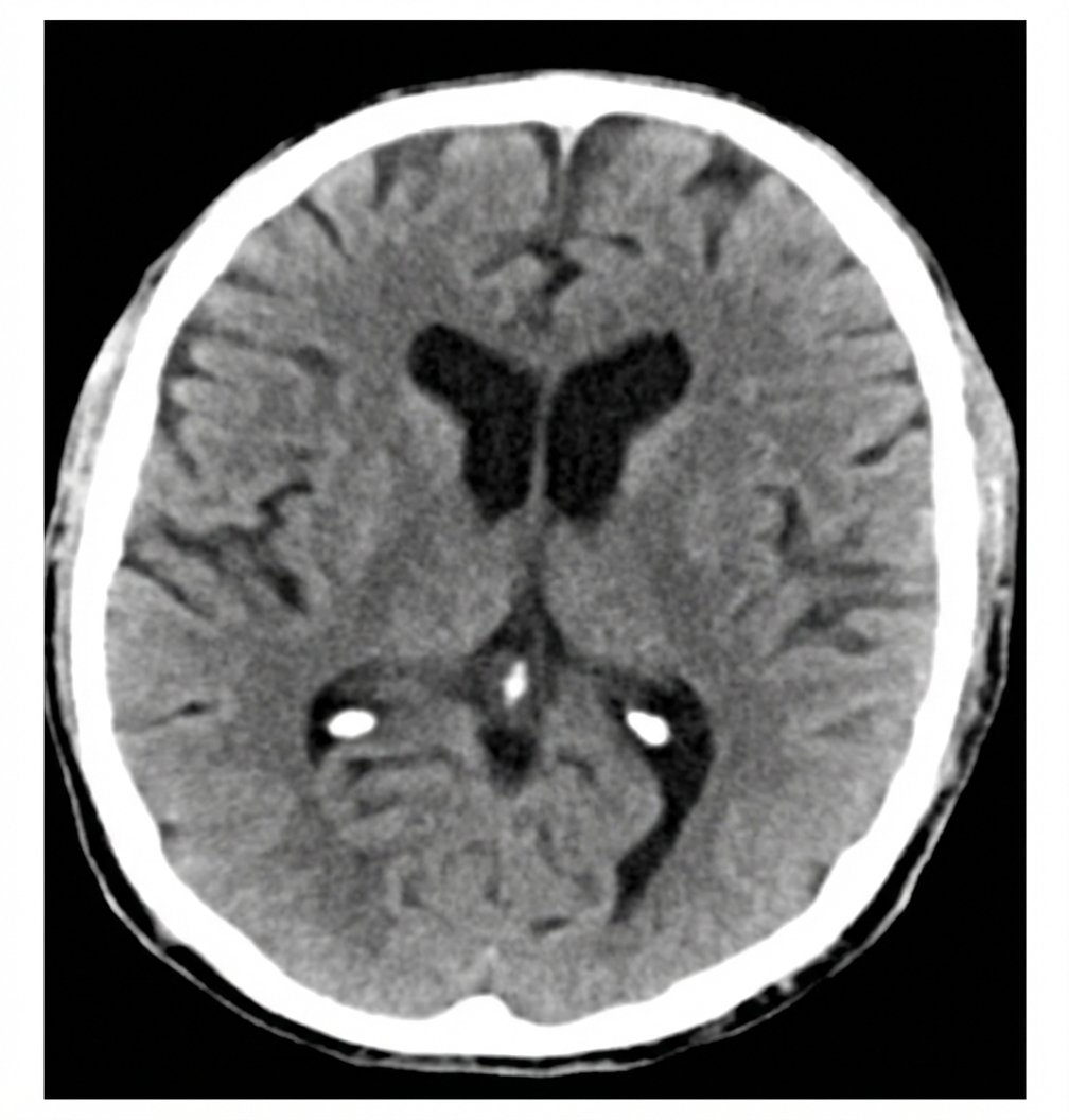 Imagem da questão de Doenças Cerebrovasculares