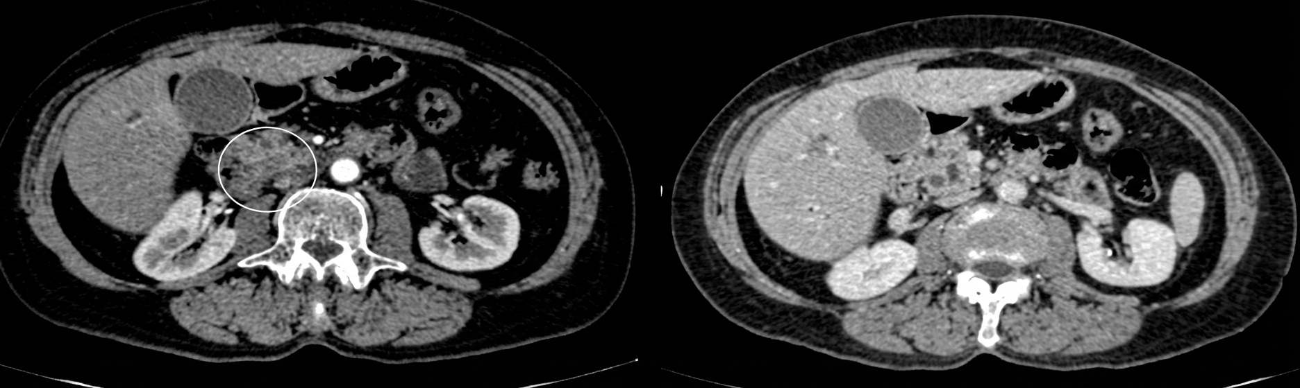 Imagem da questão de Pancreatobiliar