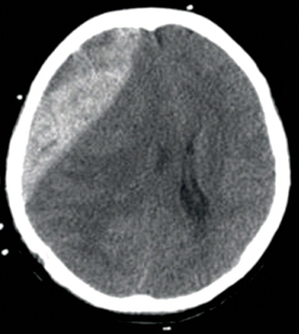 Imagem da questão de Trauma Cranioencefálico (TCE)