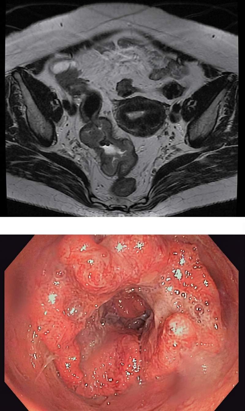 Imagem da questão de Coloproctologia