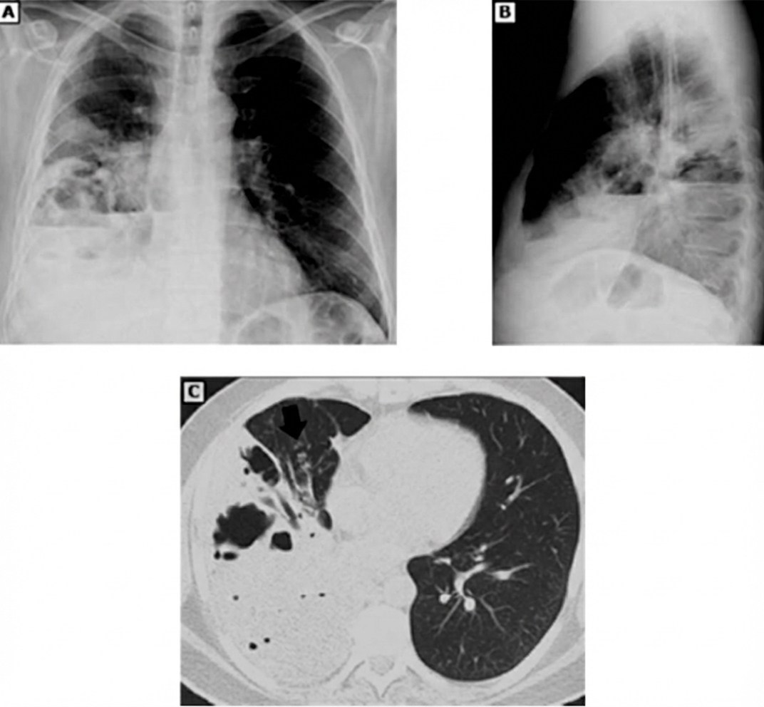 Imagem da questão de Pneumonia