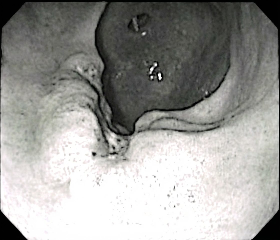 Imagem da questão de Cirurgia Gástrica