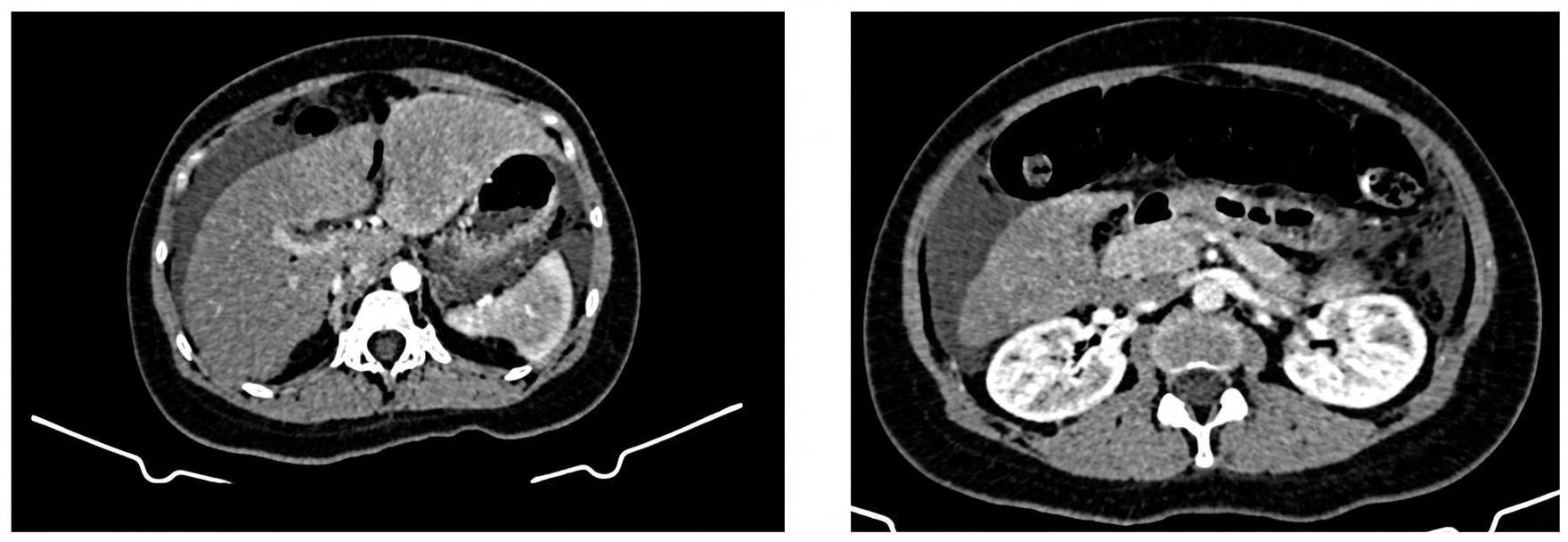 Imagem da questão de Pancreatobiliar
