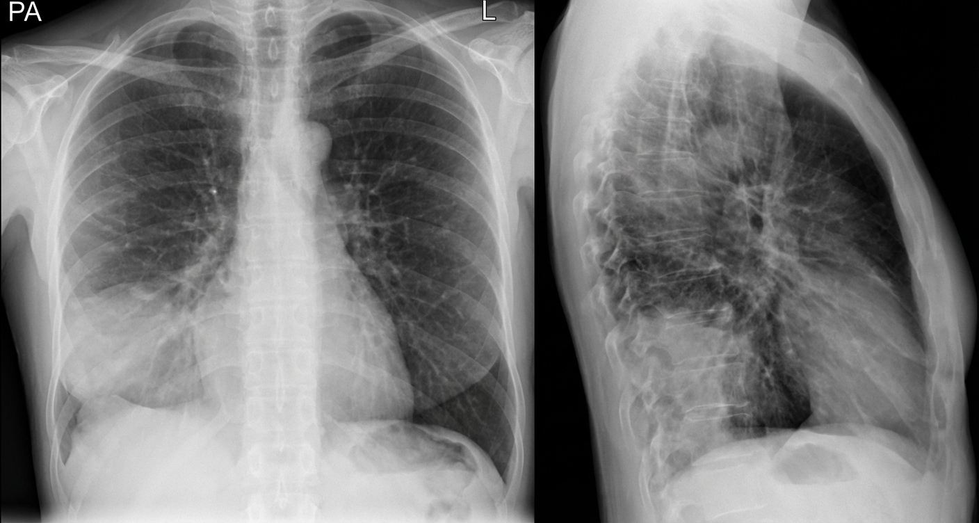Imagem da questão de Lesões Pulmonares Focais