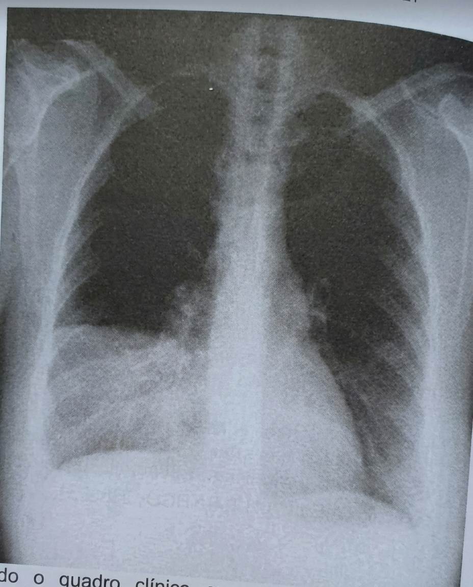 Imagem da questão de Pneumonia