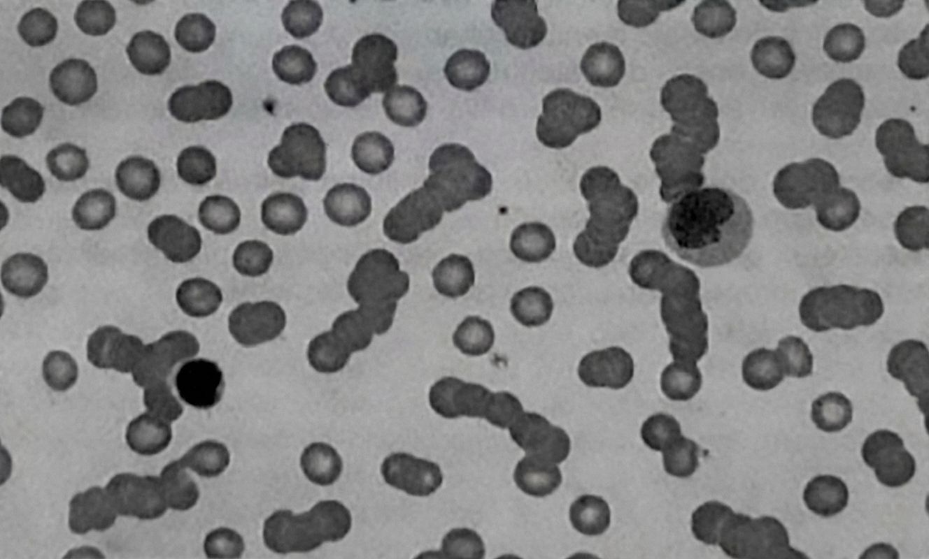 Imagem da questão de Neoplasias Hematológicas