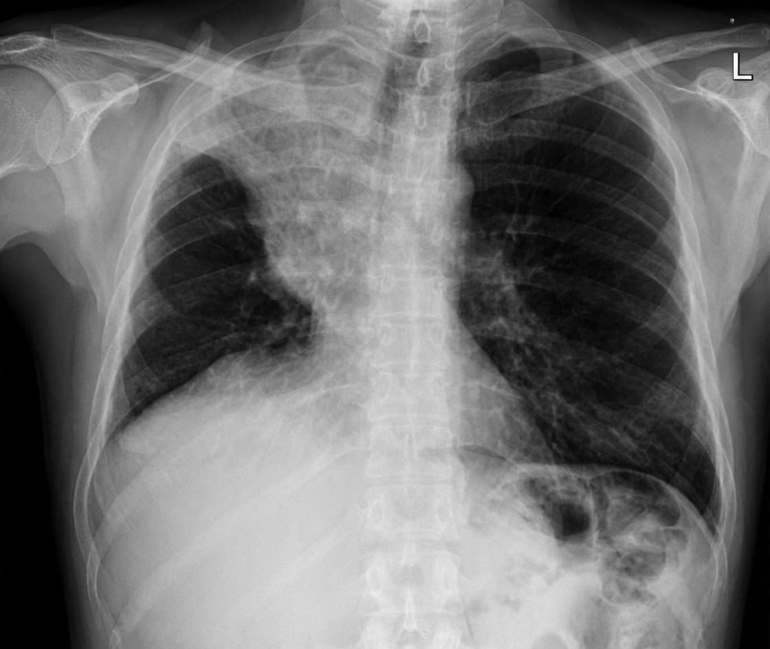 Imagem da questão de Lesões Pulmonares Focais