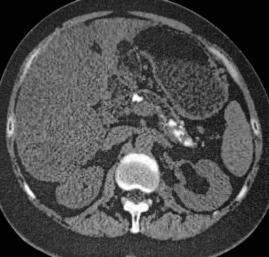 Imagem da questão de Doenças Pancreáticas