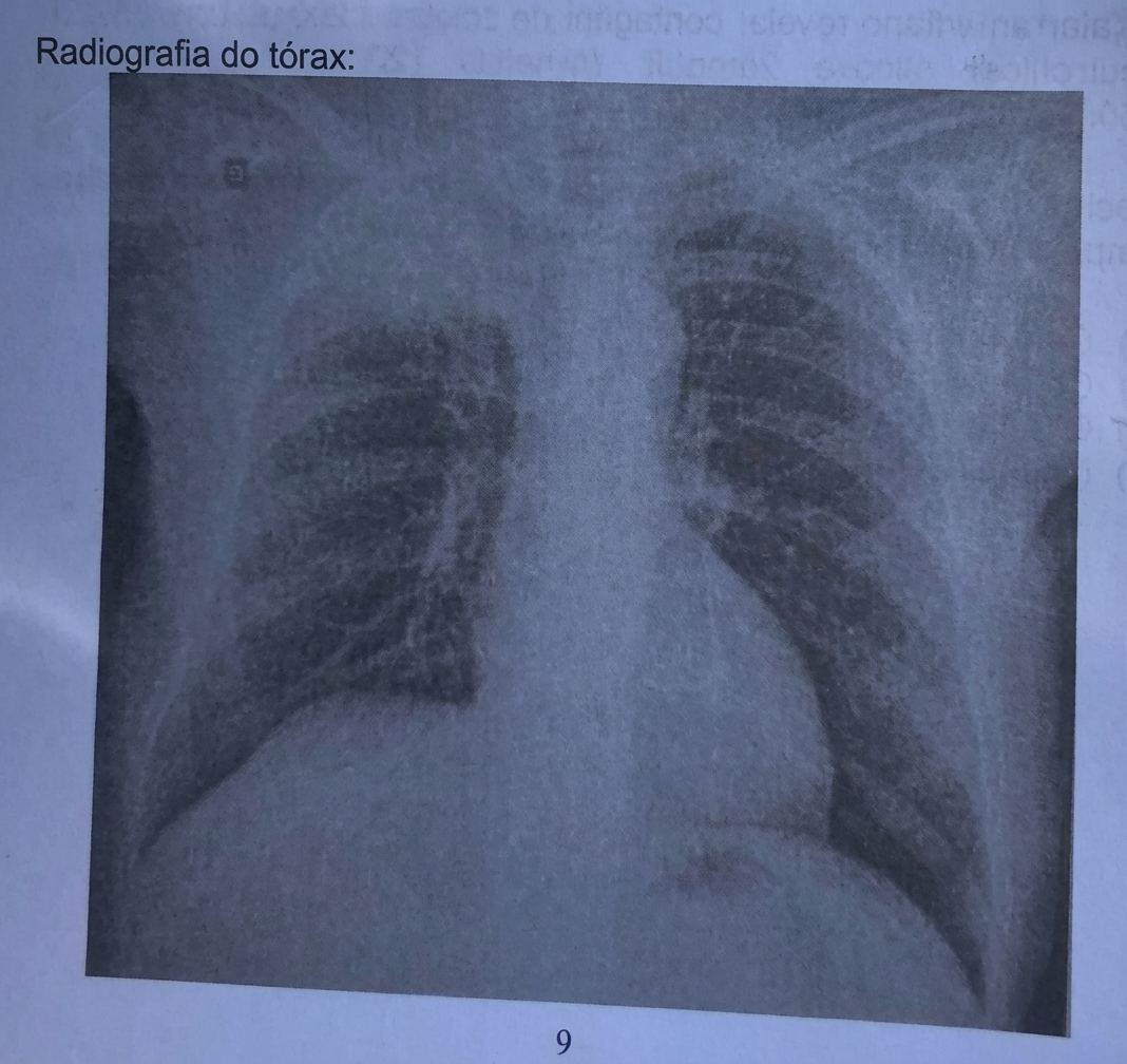 Imagem da questão de Oncologia Torácica