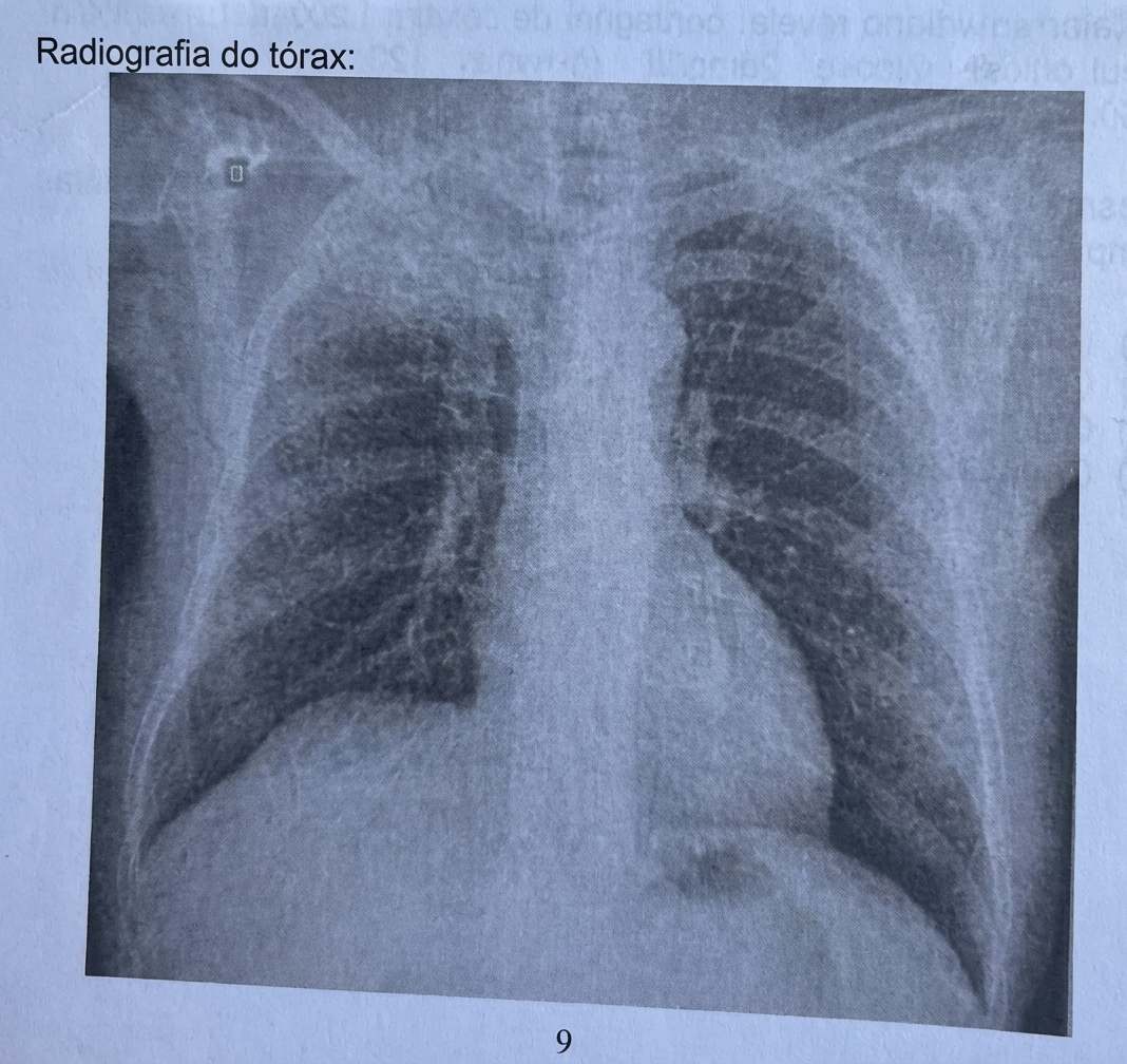 Imagem da questão de Oncologia Torácica