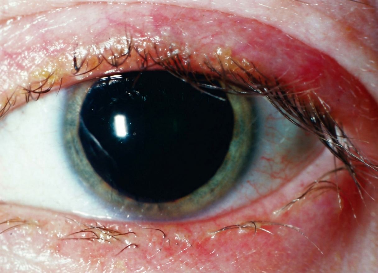 Imagem da questão de Superfície Ocular