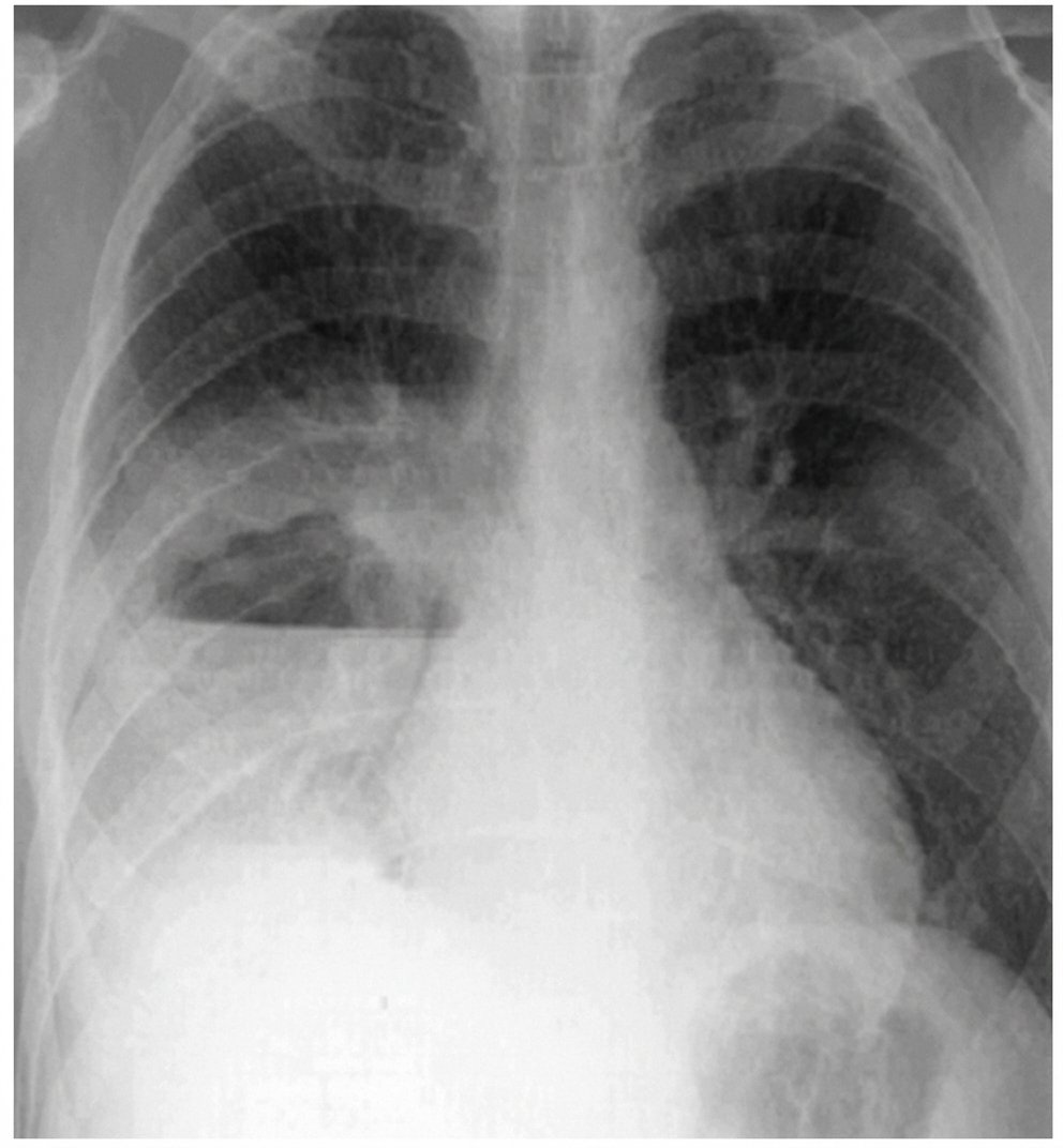 Imagem da questão de Pneumonia