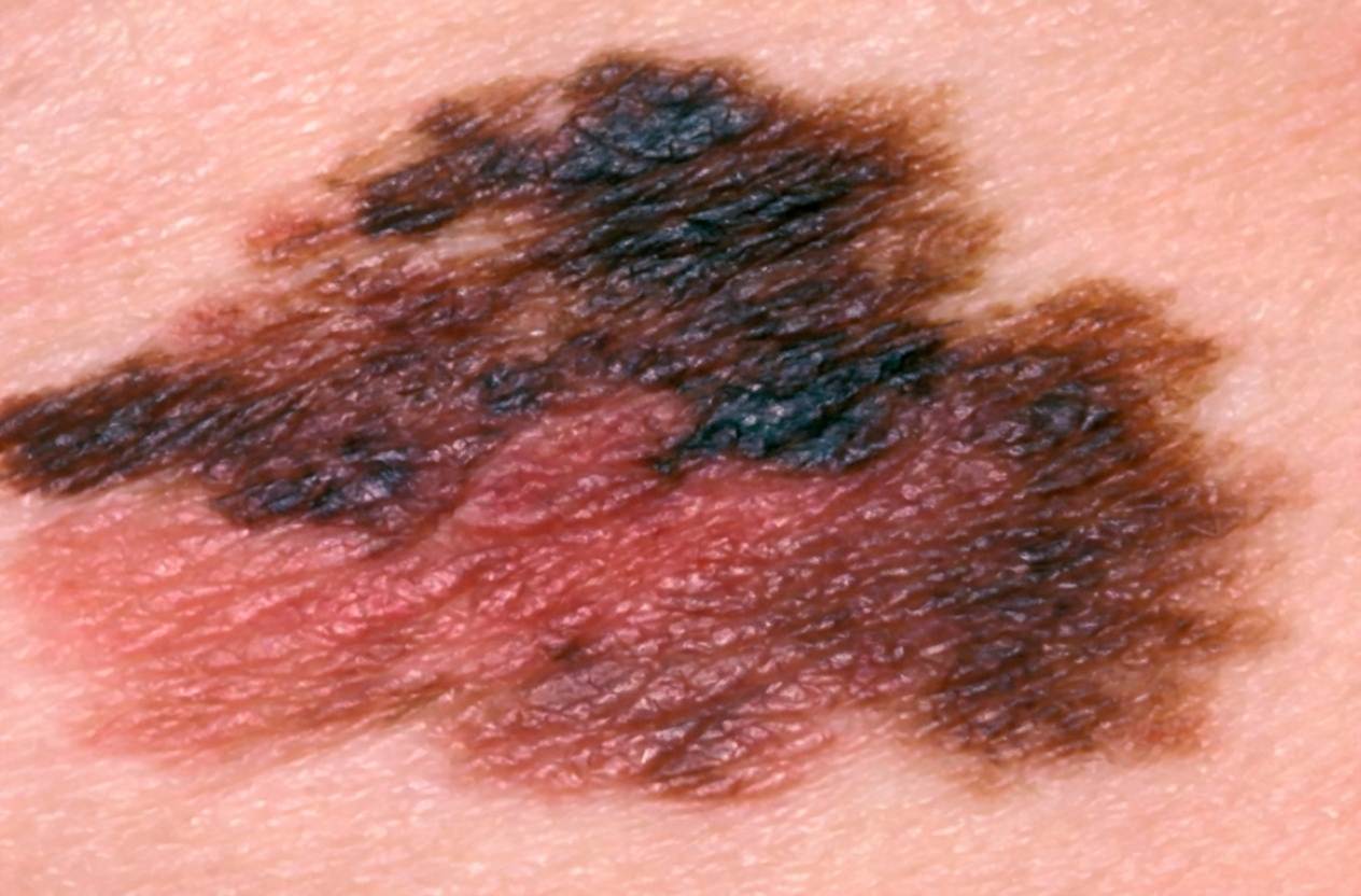 Imagem da questão de Neoplasias Cutâneas