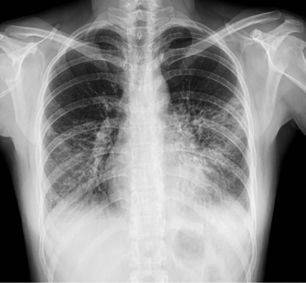 Imagem da questão de Infecções Respiratórias Baixas