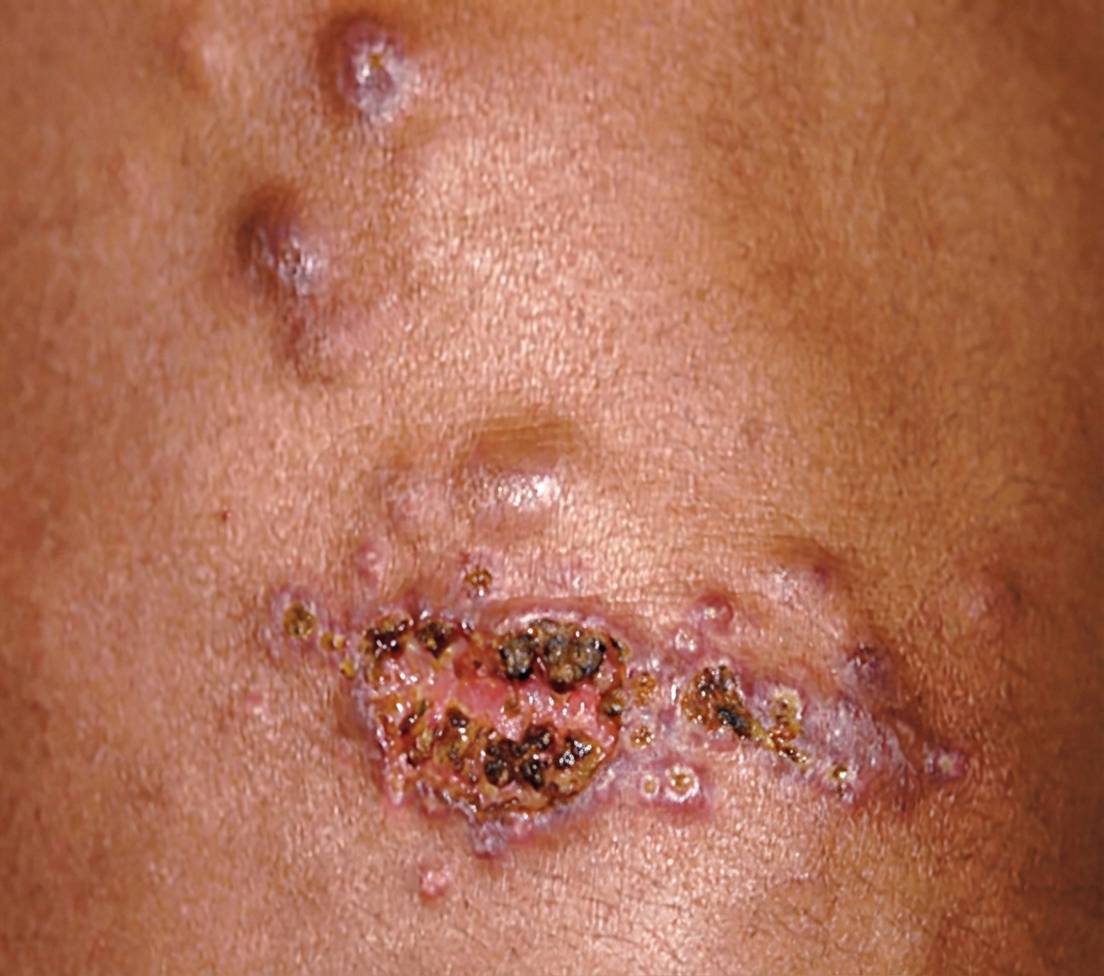 Imagem da questão de Infecções Cutâneas