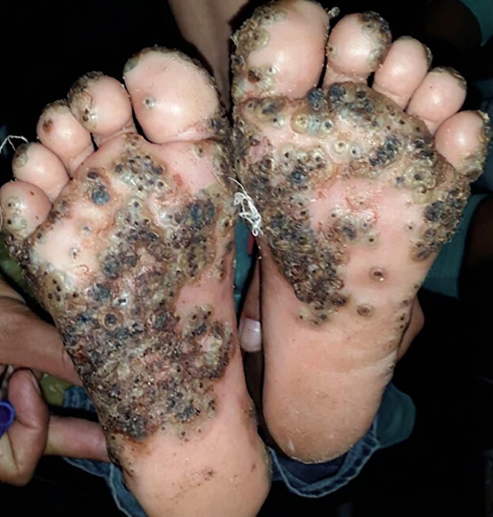 Imagem da questão de Infecções Cutâneas