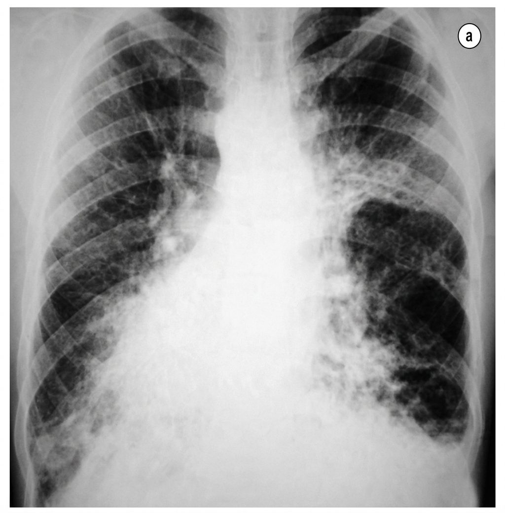 Imagem da questão de Fibrose Cística