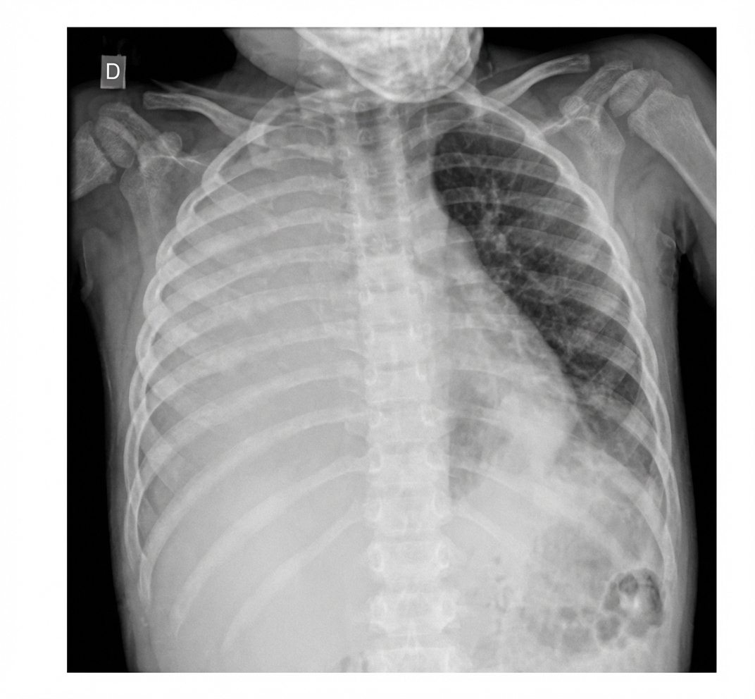 Imagem da questão de Hemoglobinopatias