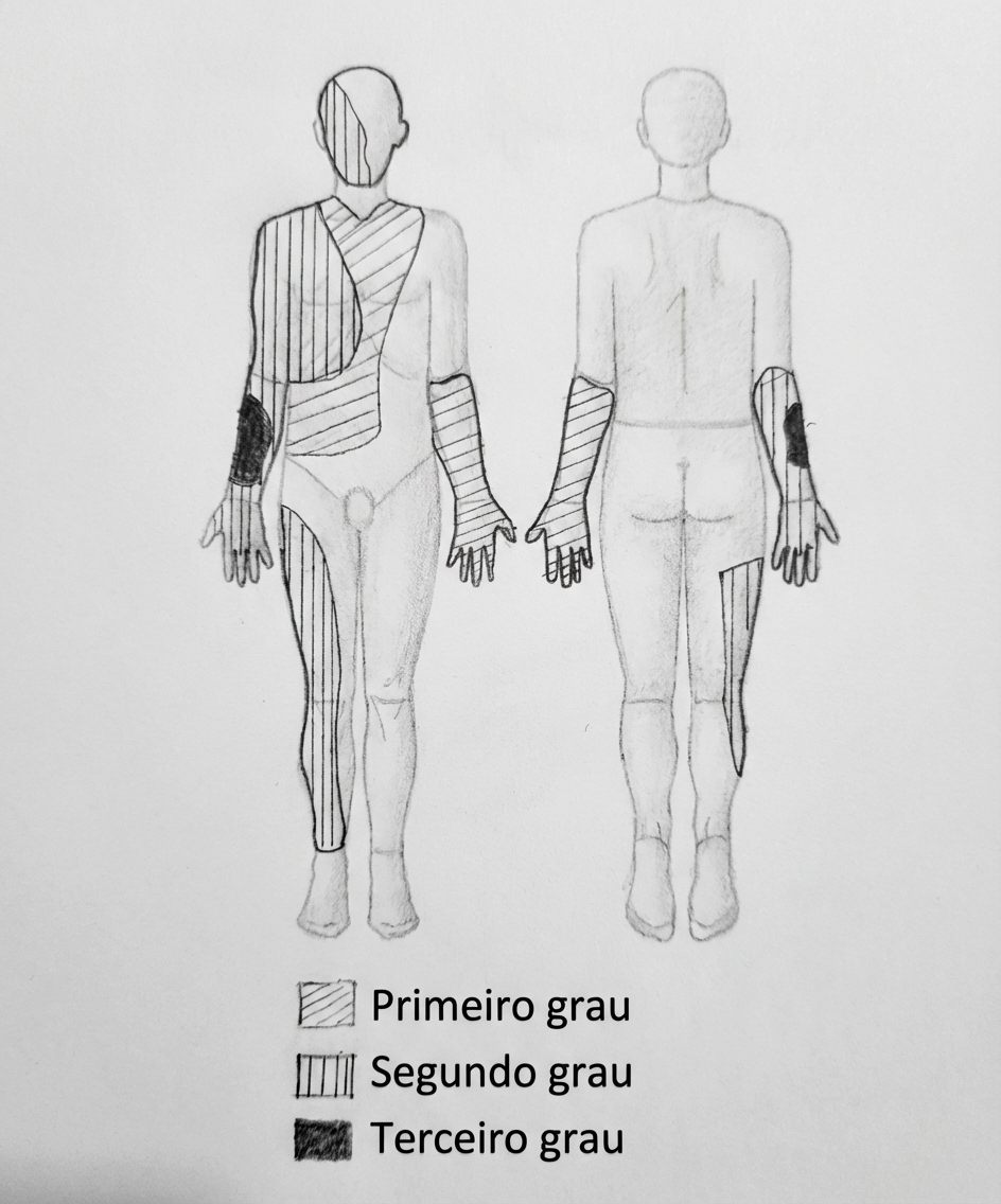 Imagem da questão de Queimaduras