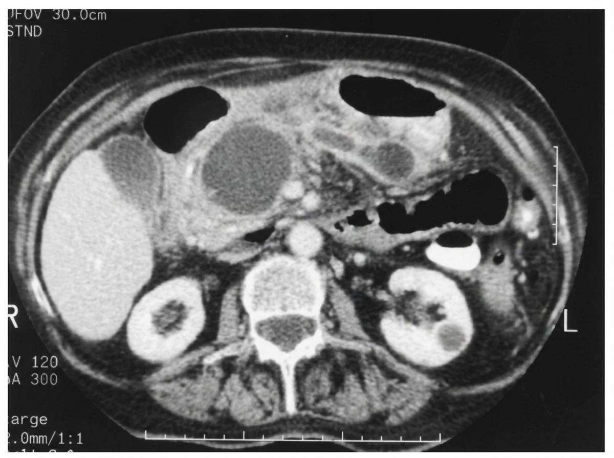 Imagem da questão de Pancreatobiliar