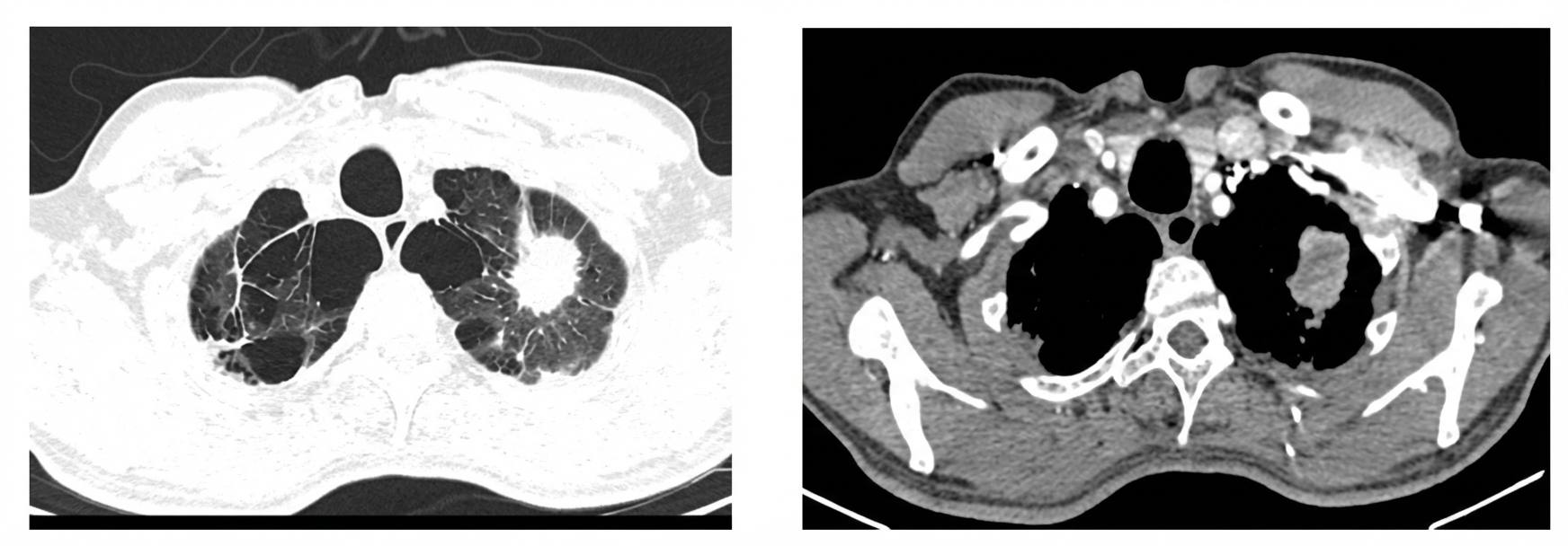 Imagem da questão de Oncologia Torácica