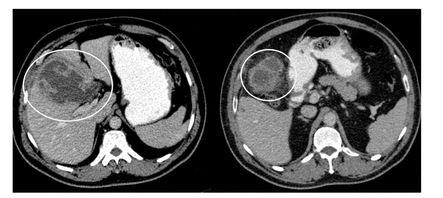 Imagem da questão de Pancreatobiliar