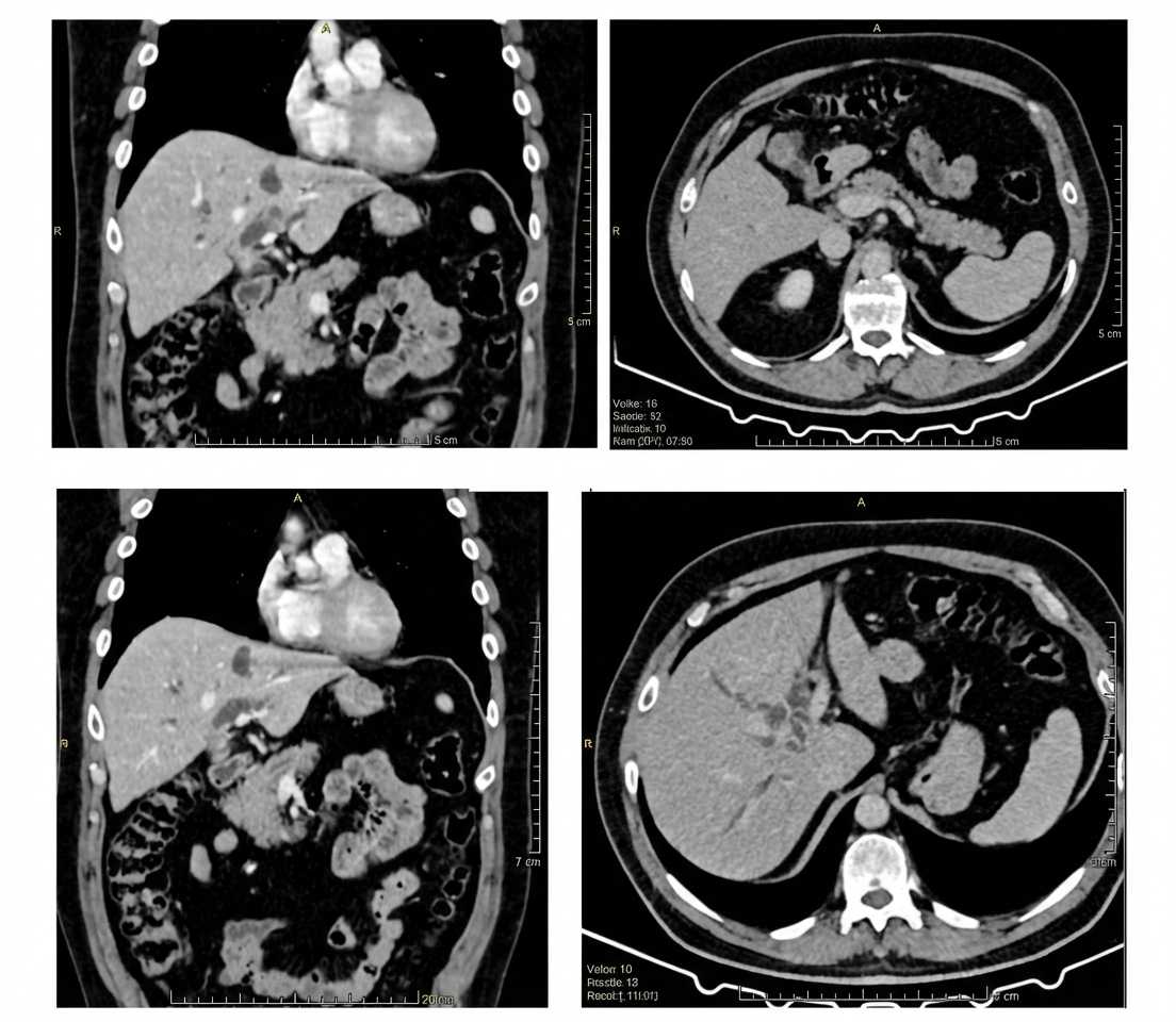 Imagem da questão de Pancreatobiliar