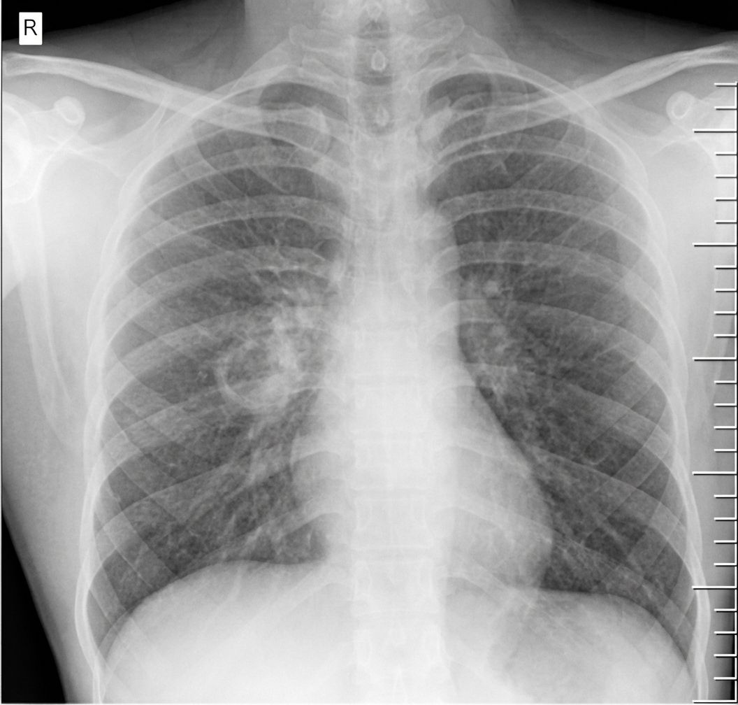 Imagem da questão de Tuberculose