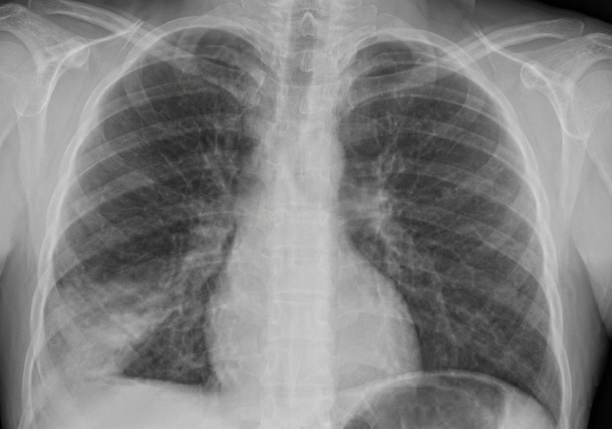 Imagem da questão de Pneumonia