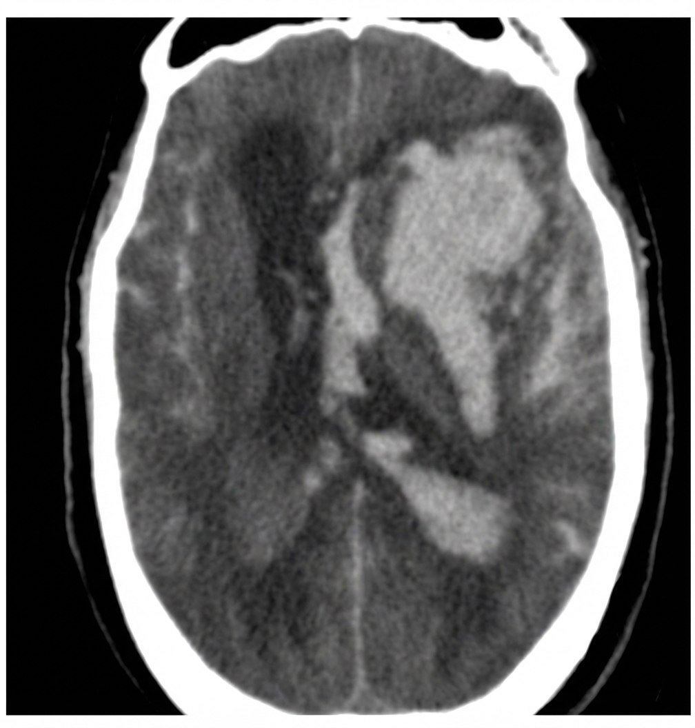 Imagem da questão de Doenças Cerebrovasculares