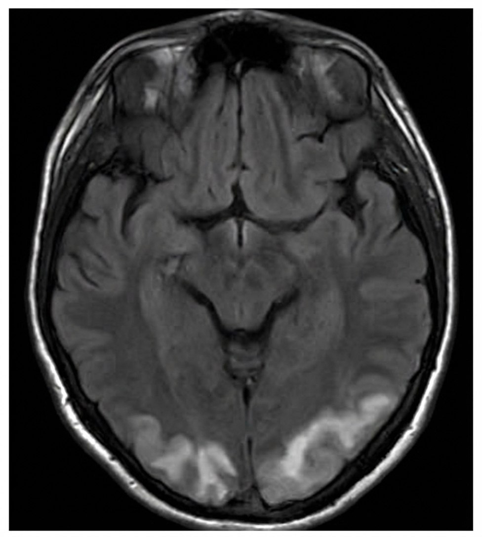 Imagem da questão de Doenças Cerebrovasculares