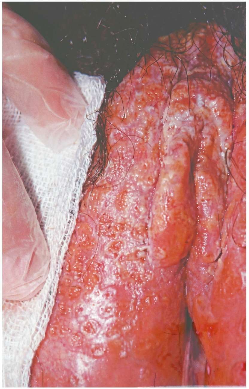 Imagem da questão de Infecções Perinatais