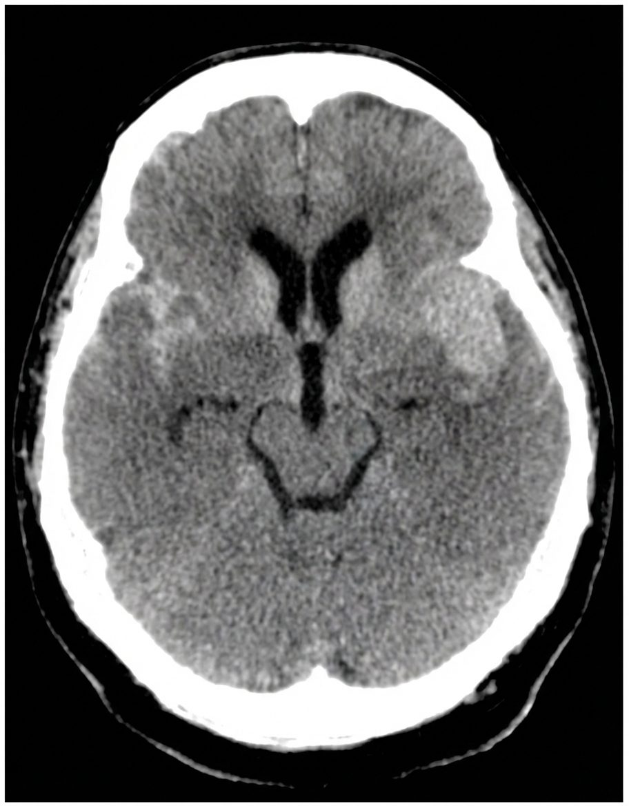 Imagem da questão de Doenças Cerebrovasculares