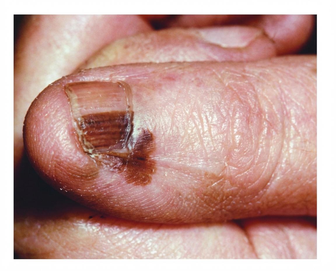 Imagem da questão de Neoplasias Cutâneas