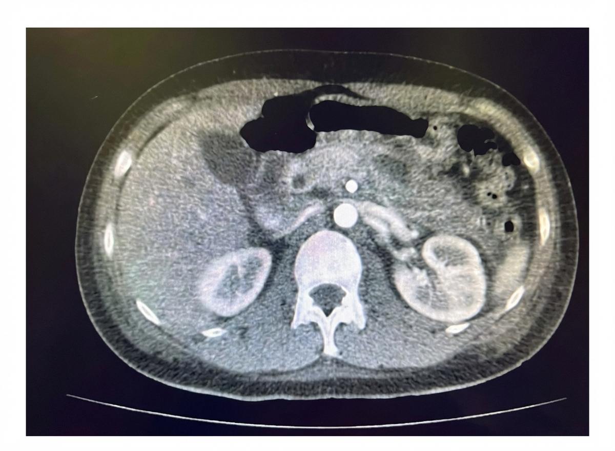 Imagem da questão de Doenças Pancreáticas