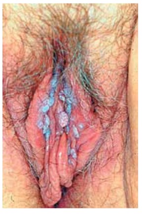 Imagem da questão de Infecções do trato genital