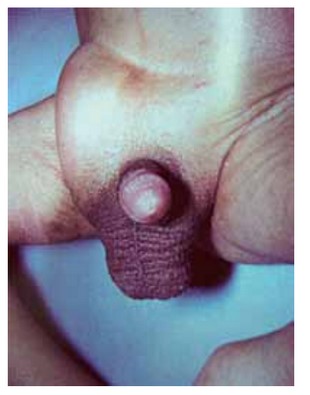 Imagem da questão de Hérnias da parede abdominal