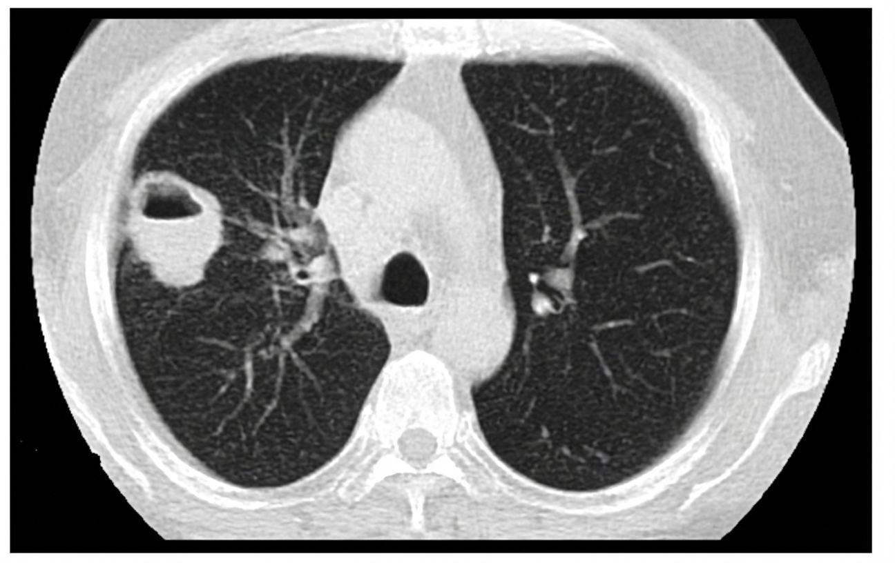 Imagem da questão de Pneumonia