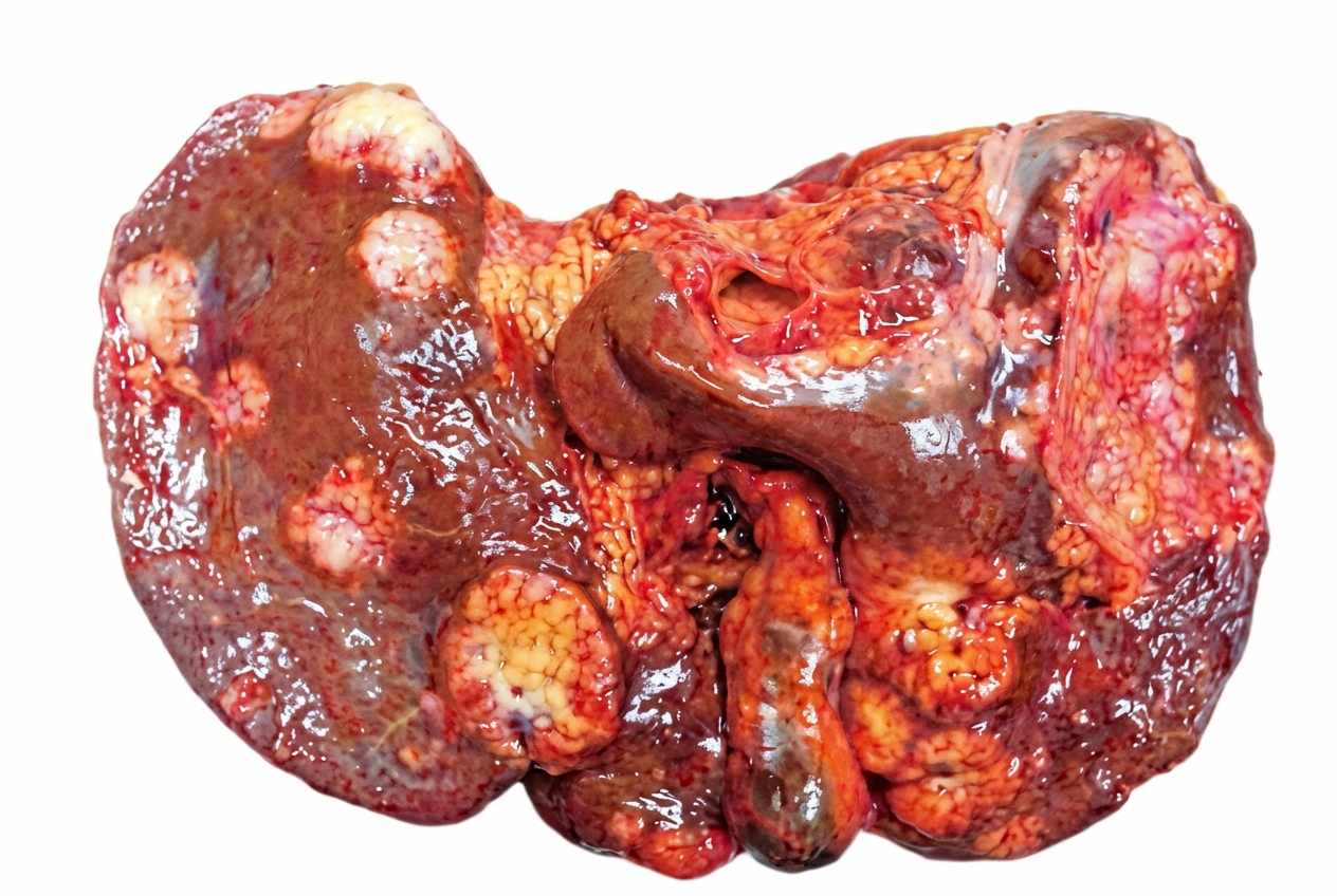 Imagem da questão de Hepatobiliar
