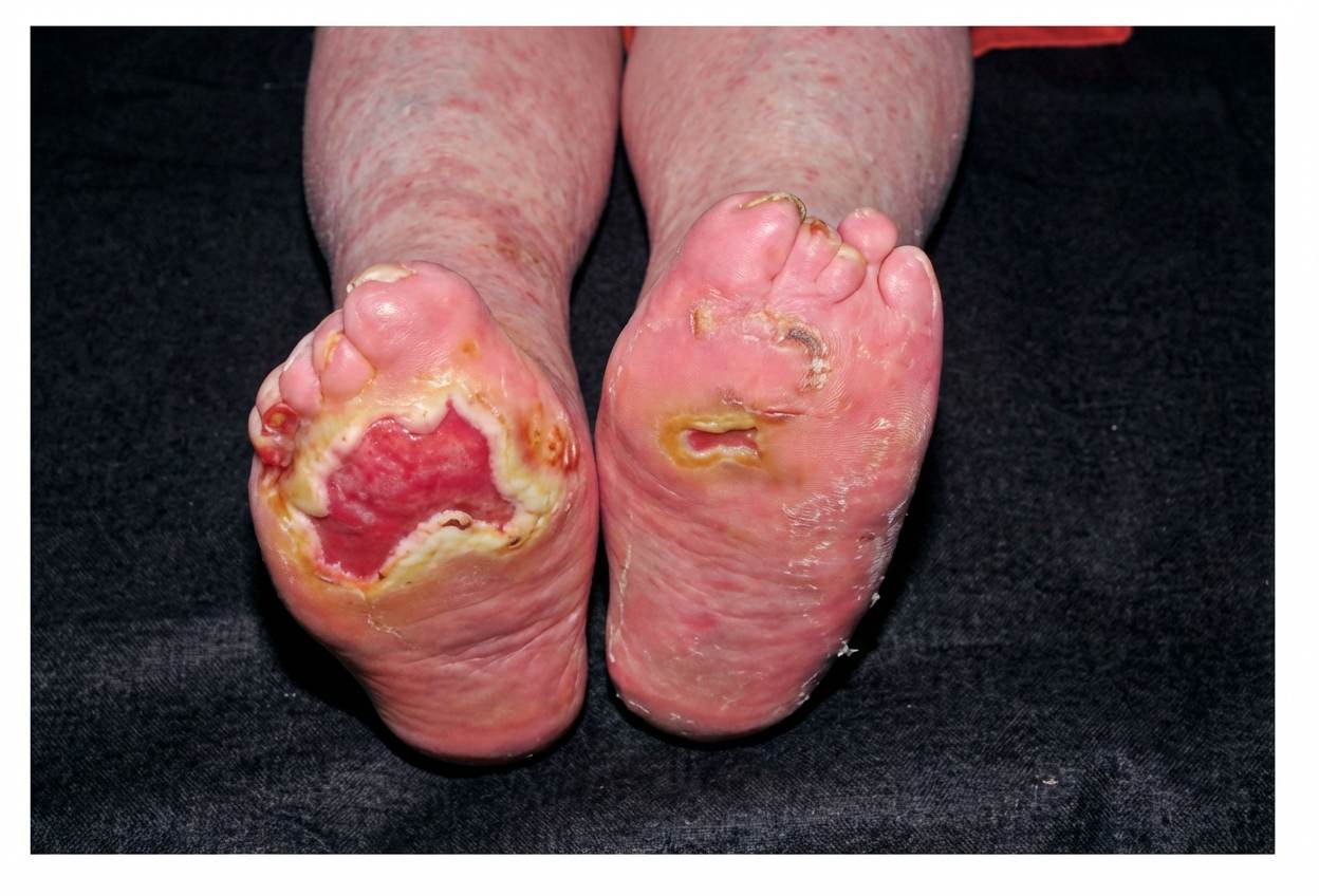 Imagem da questão de Infecções Cutâneas