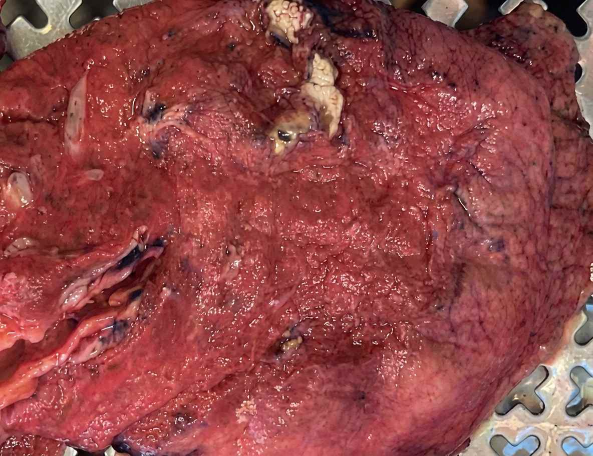 Imagem da questão de Tuberculose