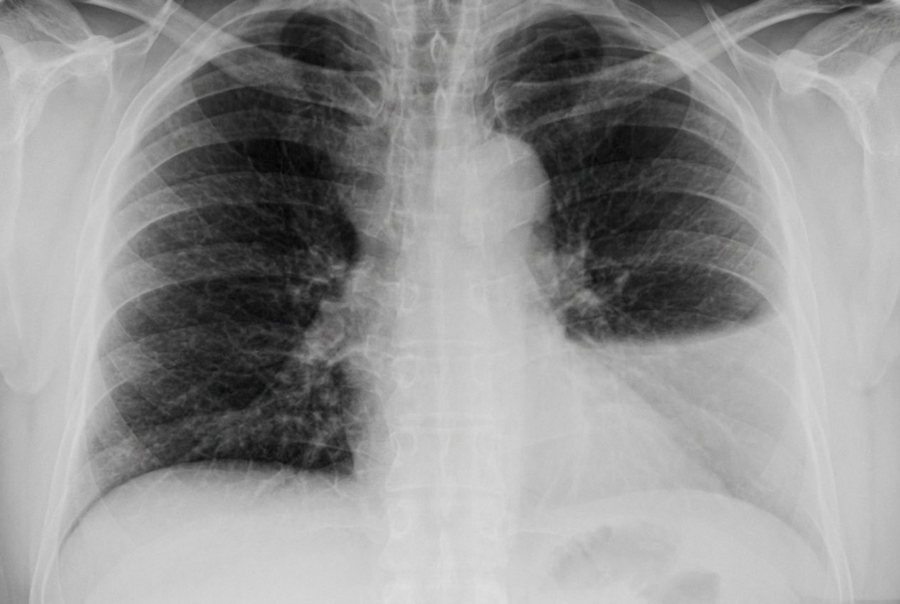 Imagem da questão de Infecções Respiratórias Baixas
