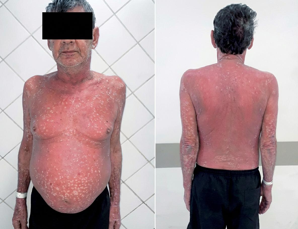 Imagem da questão de Manifestações Cutâneas Medicamentosas