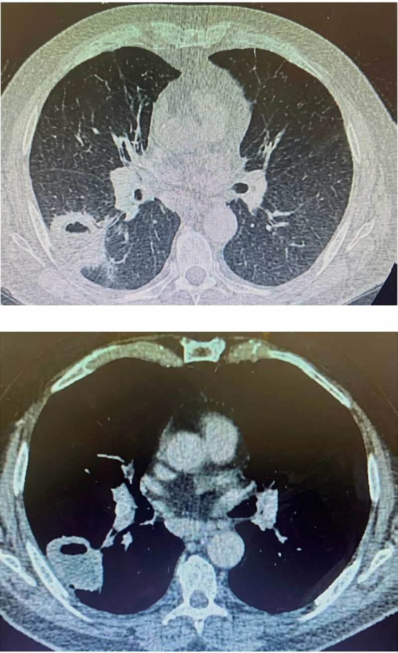 Imagem da questão de Oncologia Torácica