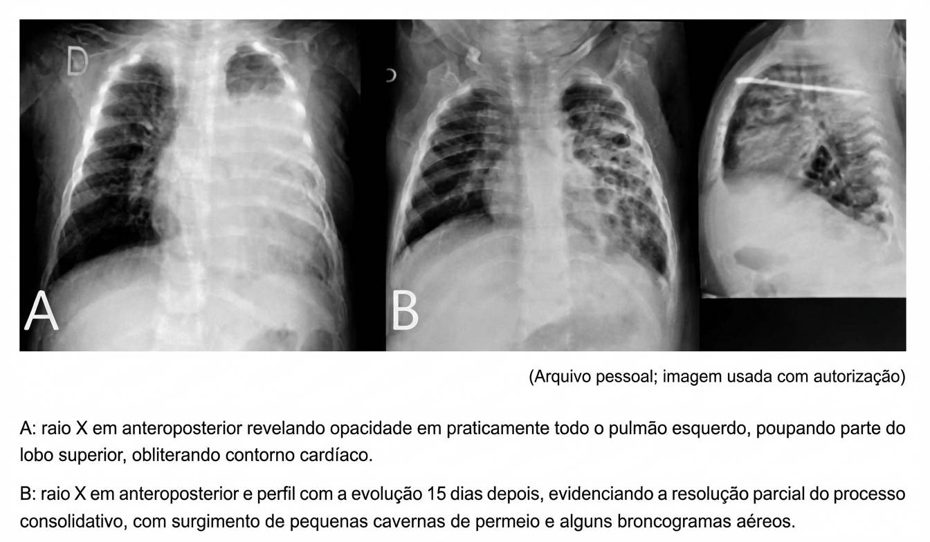 Imagem da questão de Infecções Respiratórias Baixas