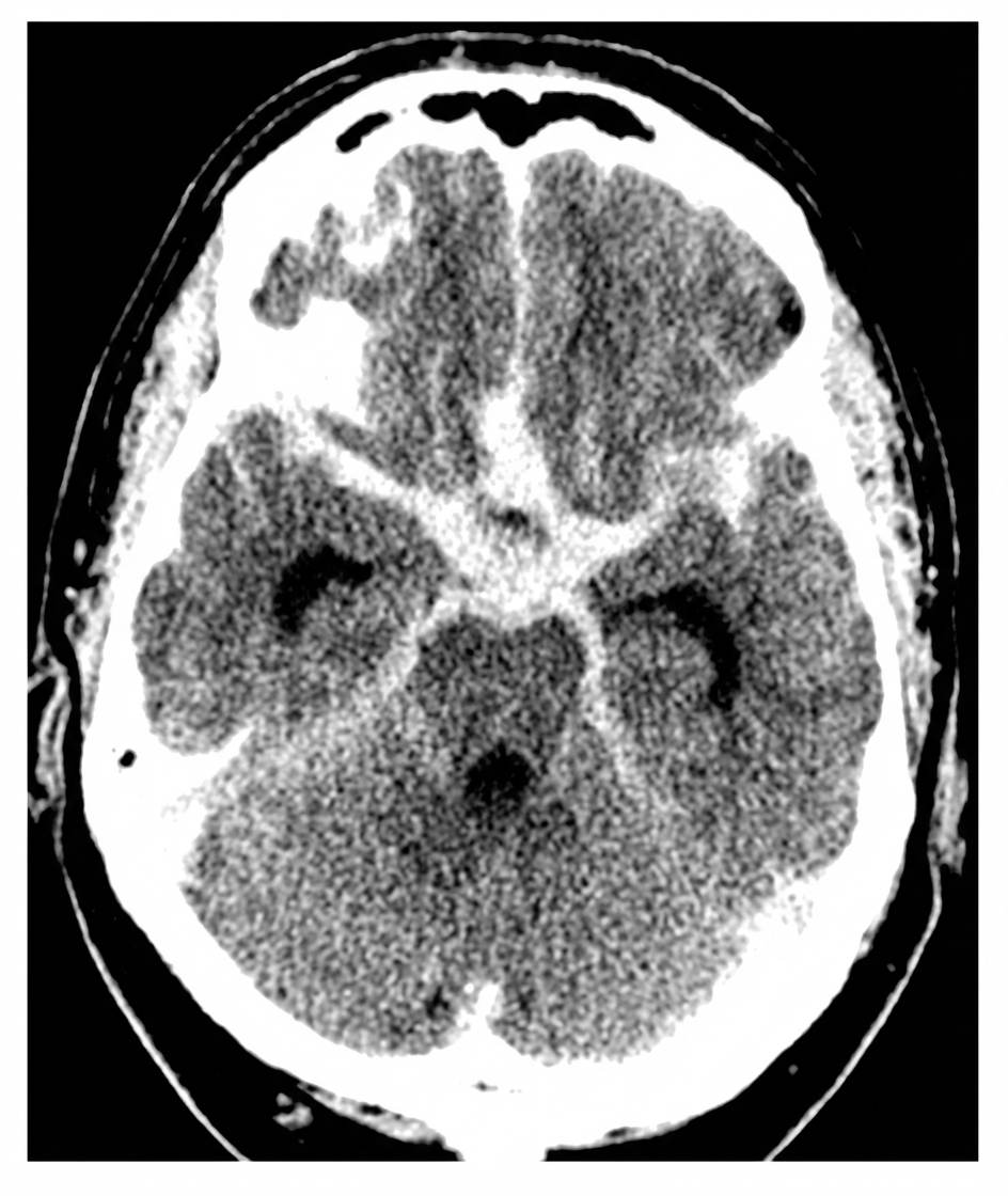 Imagem da questão de Doenças Cerebrovasculares