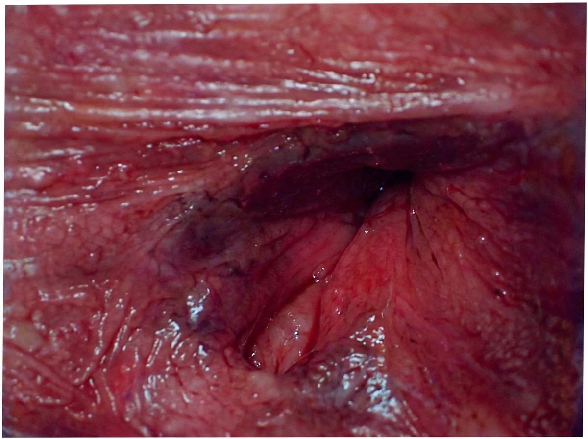 Imagem da questão de Coloproctologia