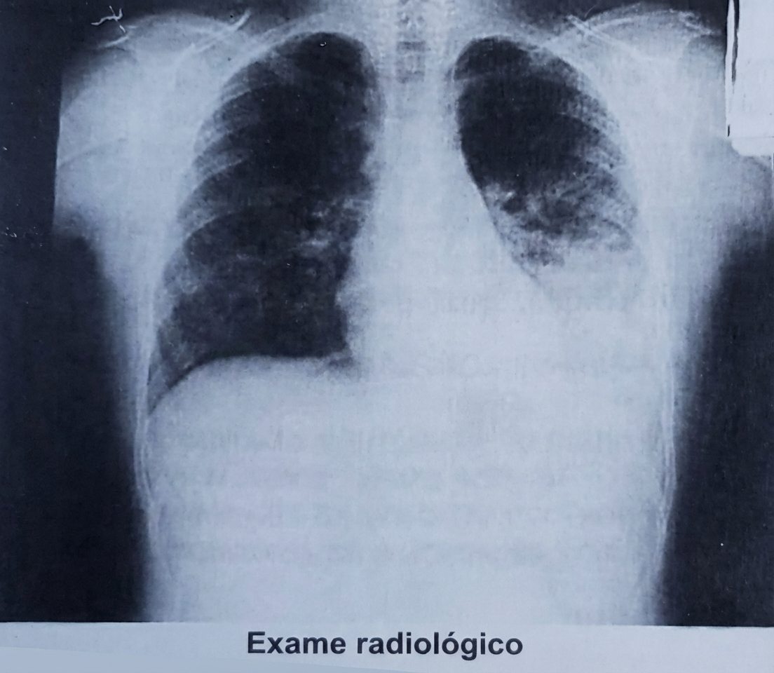 Imagem da questão de Hemoglobinopatias