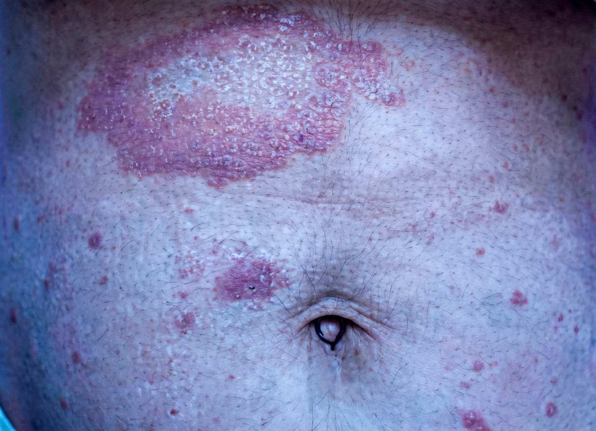 Imagem da questão de Infecções Cutâneas